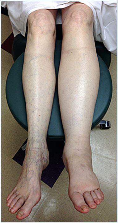 shin compression pitting edema test|pitting edema surgery.